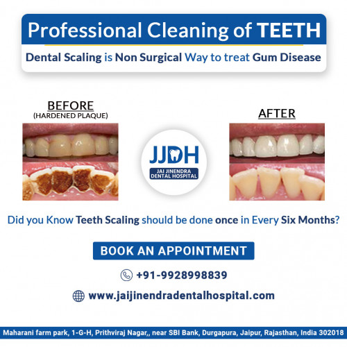 Dental Scaling Jai Jinendra hospital Jaipur