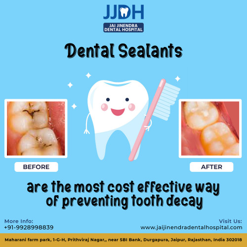 Dental Sealants Jaipur Dental Hospital Jai Jinendra