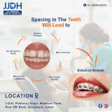 The-best-solution-of-spacing-in-the-teeth-is-the-braces-by-JJDH